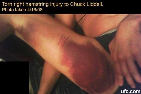 Chuck Liddell injury